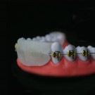 For de med tannregulering. thumbnail
